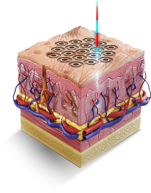 high res skin resurfacing (1) high res skin resurfacing (1)